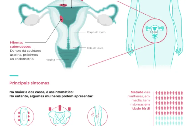 Miomas podem prejudicar mais a qualidade de 
vida das mulheres do que algumas doenças crônicas 