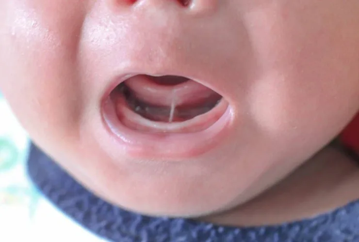 Cirurgia para "língua presa" cresce no Brasil; entidade médica pede cautela