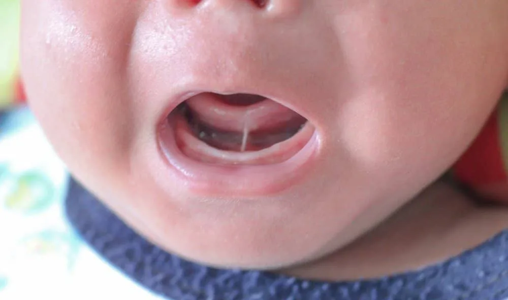 Cirurgia para "língua presa" cresce no Brasil; entidade médica pede cautela