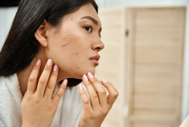 Dieta rica em alimentos antioxidantes ajuda  a melhorar a acne, diz estudo