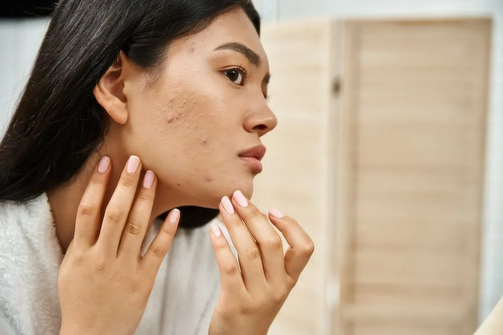 Dieta rica em alimentos antioxidantes ajuda  a melhorar a acne, diz estudo