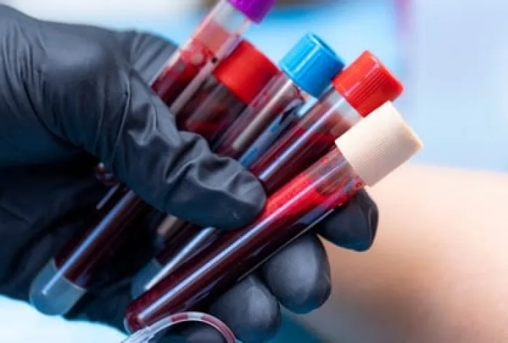 Brasileiros investigam como terapias celulares podem ajudar a tratar leucemia