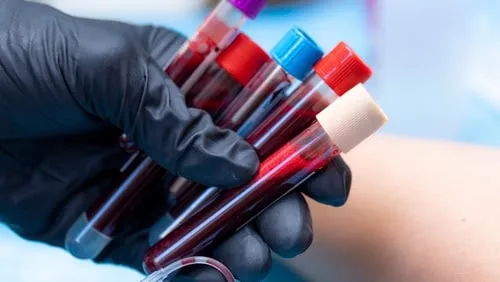 Brasileiros investigam como terapias celulares podem ajudar a tratar leucemia