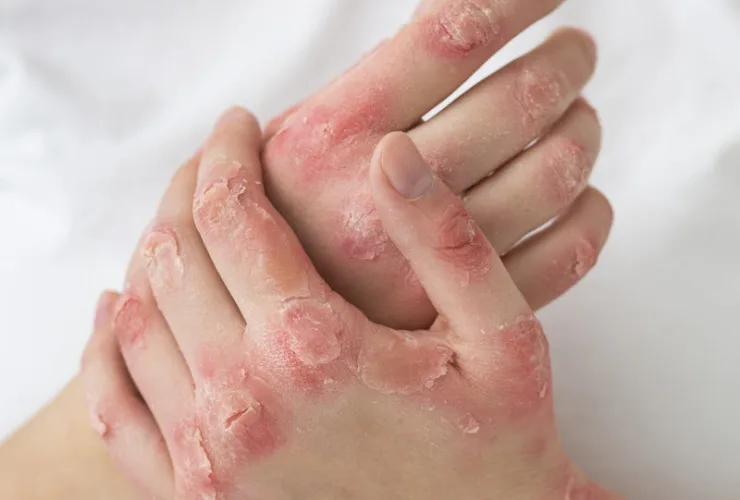 Psoríase ainda é cercada de estigmas e exige diagnóstico precoce, alertam dermatologistas do CEJAM