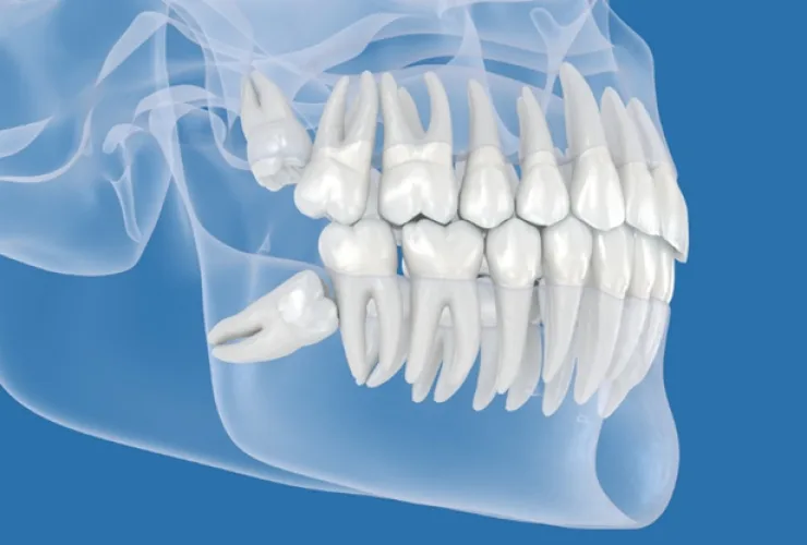 Radiografia odontológica mostrando dentes do siso em diferentes estágios de desenvolvimento na arcada dentária