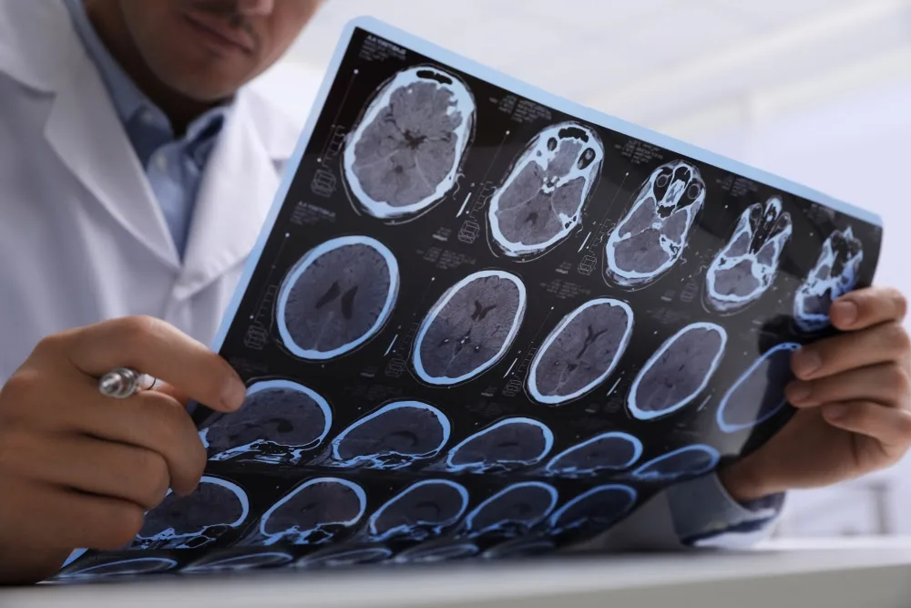 Avanços permitem diagnosticar esclerose múltipla antes dos sintomas