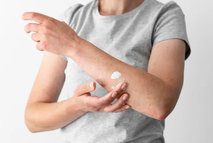 Dermatite, caspa e psoríase: como proteger a pele no inverno