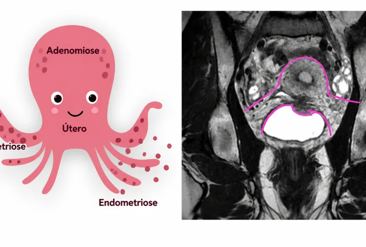 Cólica intensa não é normal e pode indicar endometriose, alerta médico do Paraná